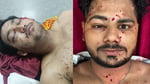 Pellet gun injuries reported by 25 year old student protester during Delhi demonstration on 20 July 2026