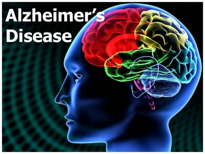 Alzheimer’s disease