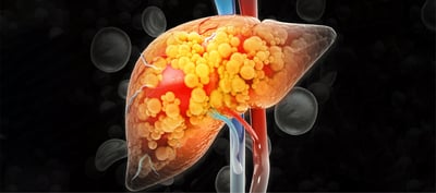 Fatty Liver Disease Has Five Different Subtypes Scientists Discover In Major Medical Breakthrough For Targeted Liver Care